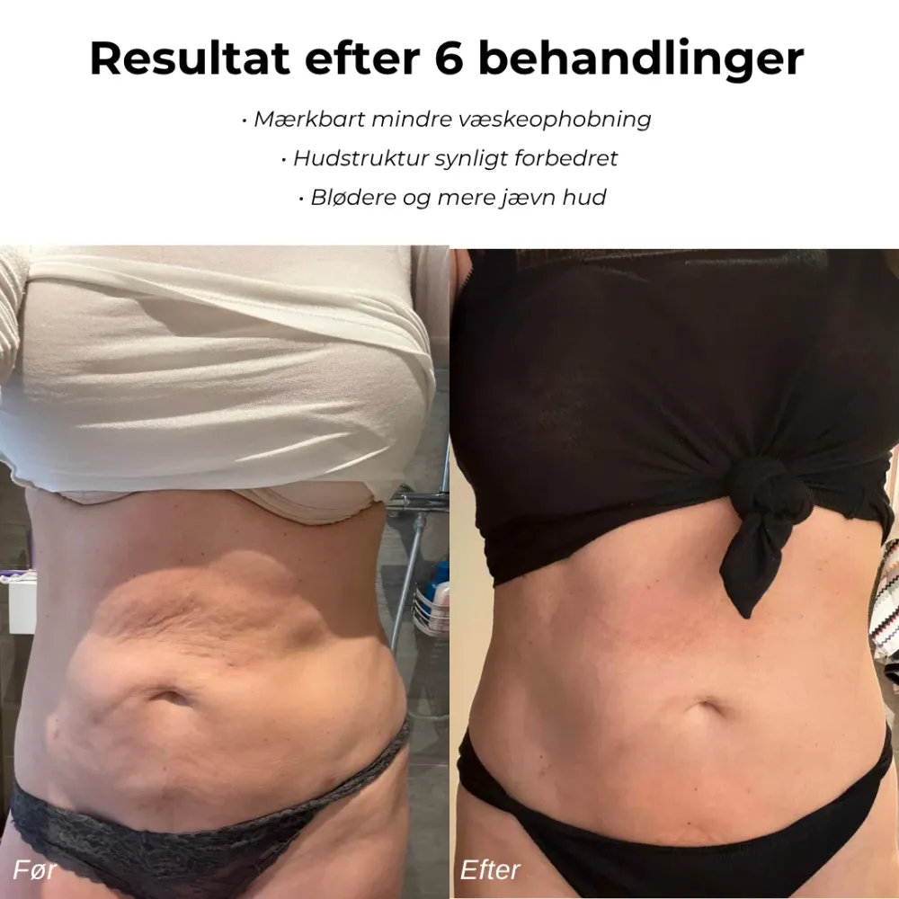 CelluSmooth™ - Anti cellulite massageapparat Home & Workshop